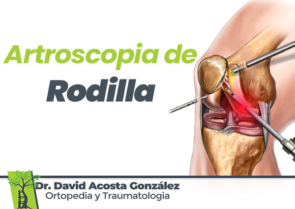 Artroscopia-de-Rodilla-Dr-David-Acosta-Ortopedia-y-Traumatologia-en-Chihuahua