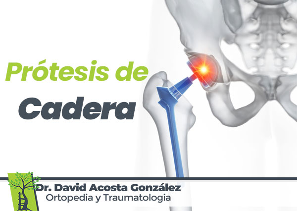 Protesis-de-Cadera-Dr.-David-Acosta-Gonzalez-Ortopedia-y-Traumatologia-en-Chihuahua
